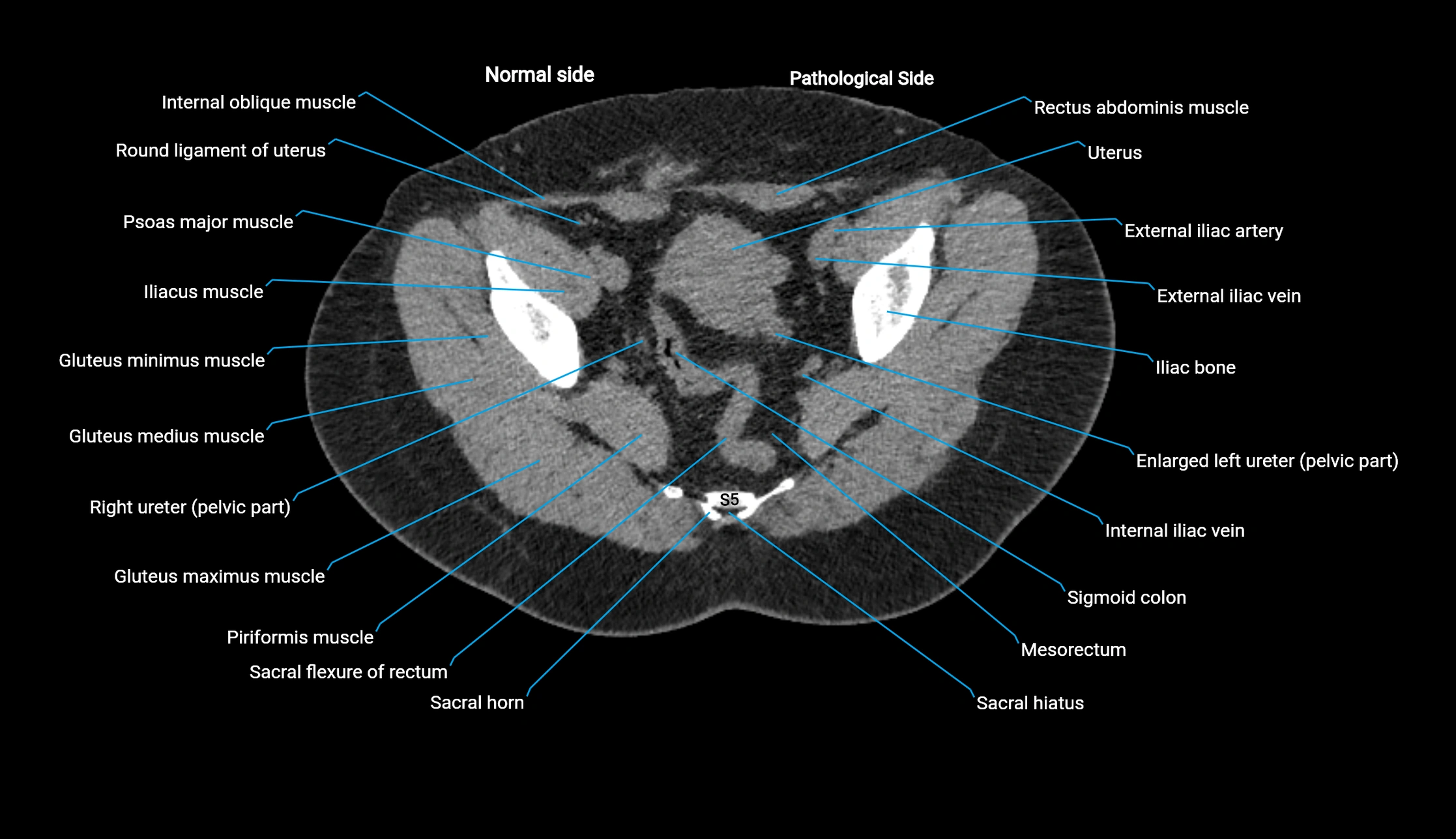 CT KUB axial cross sectional anatomy  radiology image -img-00201-00142.webp